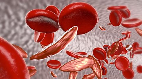 FDA approves sickle cell treatment, the first in almost two decades FDA approves sickle cell treatment, the first in almost two decades